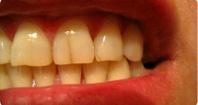 Нарушение цвета зуба, трещины