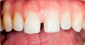 Увеличенные промежутки между зубами