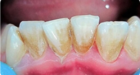 Сильная стираемость зубов