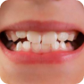 Дефекты прикуса и формы зубов