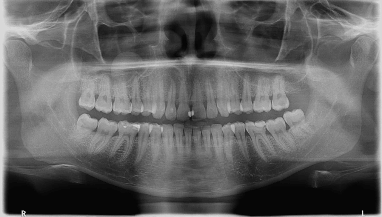 Снимок зуба Томск Живописный Удаление зубов под наркозом Томск Строительный