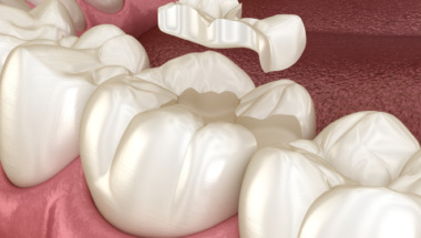 Поговорим о восстановлении зуба керамической вкладкой?