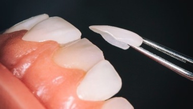 Керамическая реставрация зубов